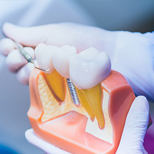 The image shows a dental model with a drilled tooth and a dental implant screwed into the socket, being held or displayed by a person wearing gloves.